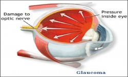 O que é glaucoma?